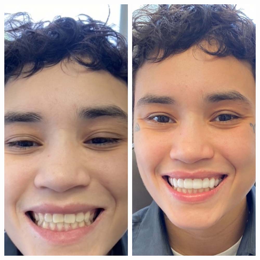 BellaVeneers Snap-on Veneers Give You a Perfect Smile Without Grinding Teeth! Smile transformation with BellaVeneers pop-on veneers by Dental Lab Direct