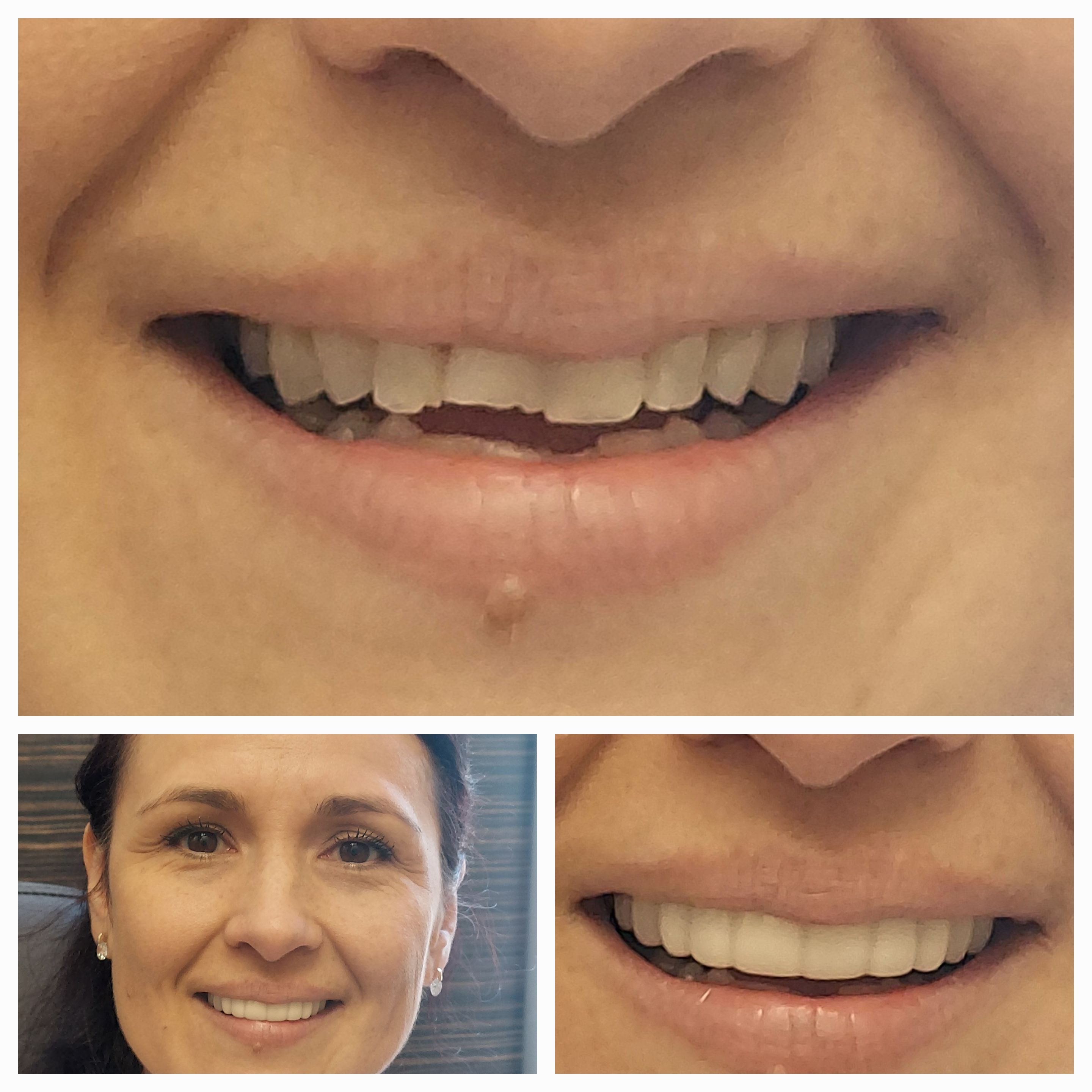 BellaVeneers Snap-on Veneers Give You a Perfect Smile Without Grinding Teeth! Can snap-on veneers hide broken or chipped teeth? Absolutely!