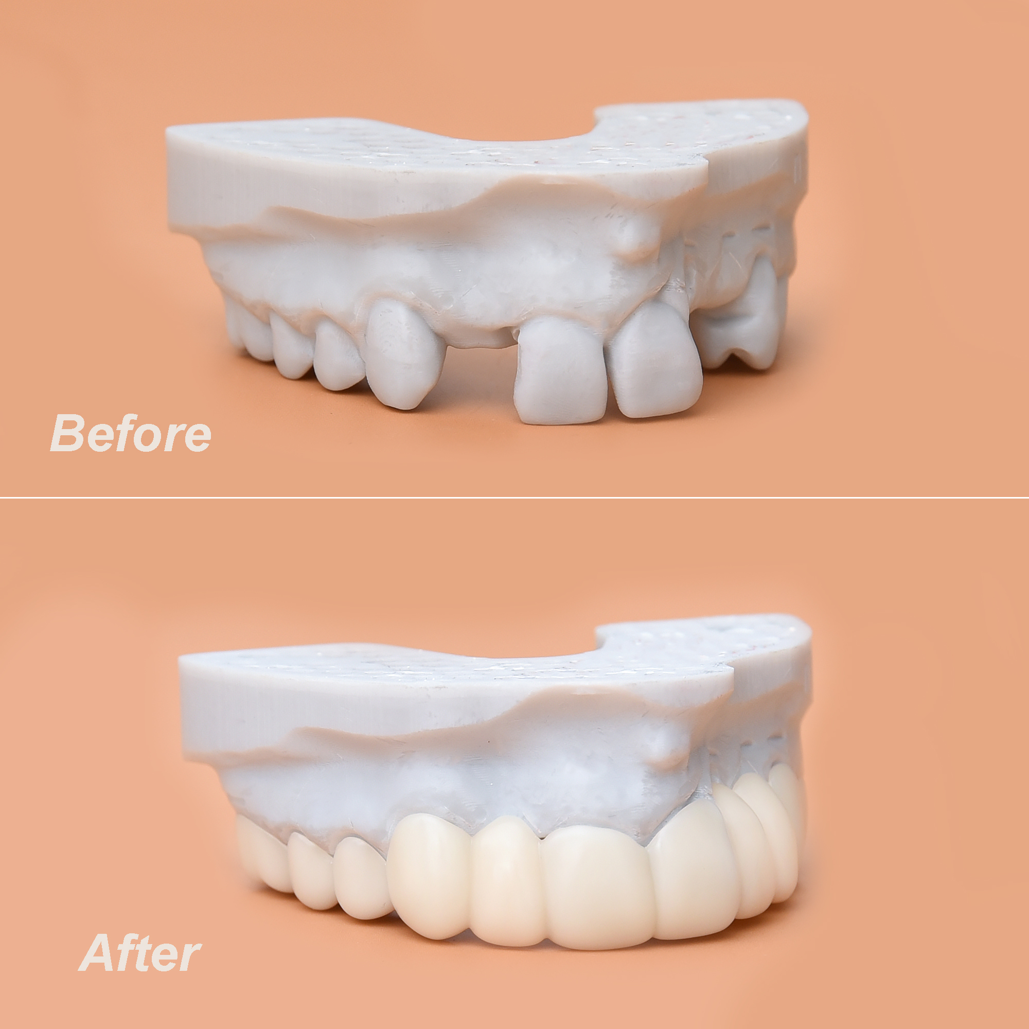 Snap-on veneers before and after pics. BellaVeneers can give you a beautiful smile!