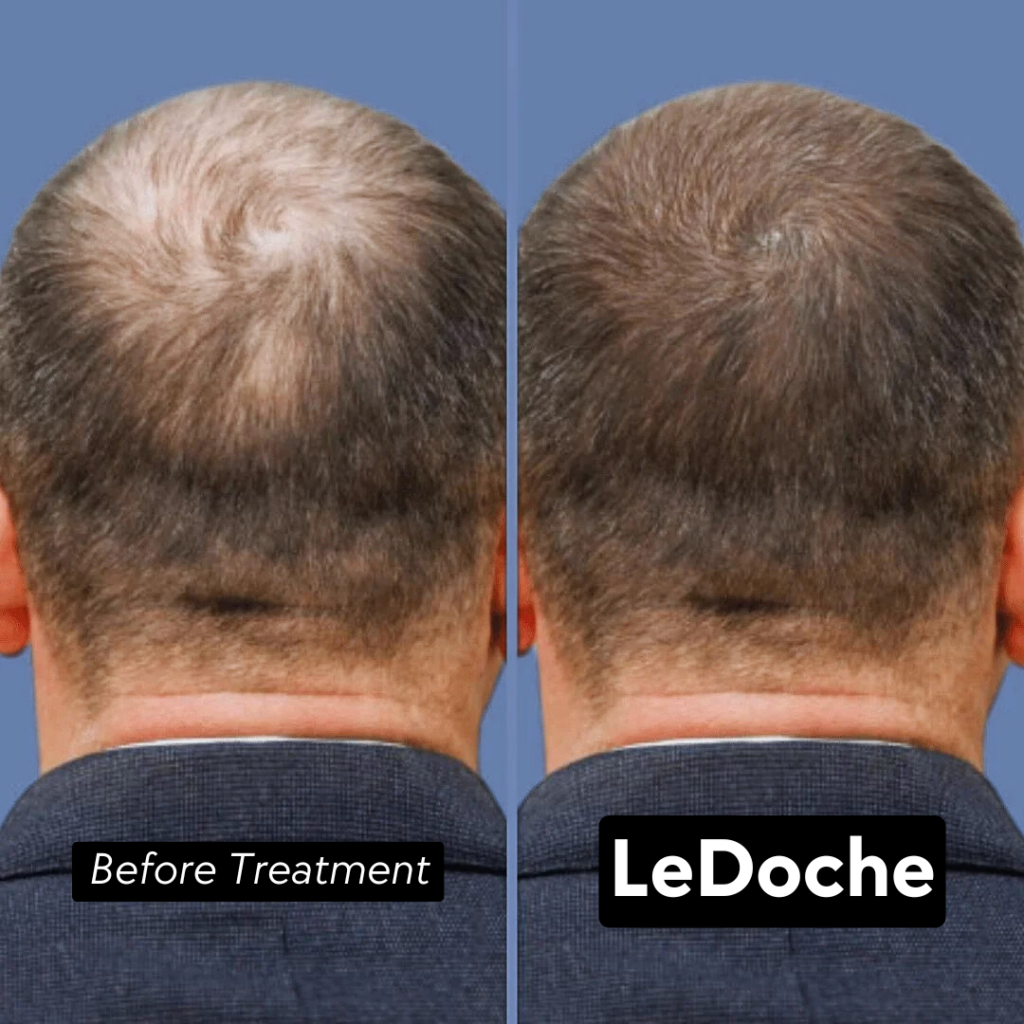 LeDoche Red Light Therapy Hat - My #1 Solution for Hair Regrowth and Male Baldness LeDoche red light therapy hat - Before and After pics
